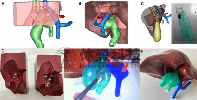 用于模拟腹腔镜与机器人胆肠吻合术的优化可重复使用模块化3D打印胆总管囊肿模型